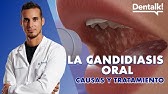 ¿HONGOS en la BOCA? Causas, prevención y tratamiento de la CANDIDIASIS oral y BOQUERAS | Dentalk! ©