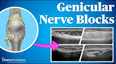 Ultrasound Guided Genicular Blocks (2024 update!)