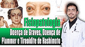 Fisiopatologia  do Hipertiroidismo e Hipotiroidismo│ PORTH