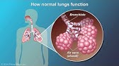 Understanding COPD