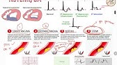 Sindrom Koroner Akut (SKA/ACS) - EKG, Patofisiologi, Diagnosis, Tatalaksana