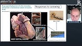 How To Do Left Bundle Branch Pacing