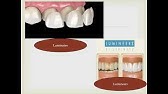 Aesthetic Alternatives For Tooth Restoration. Dr. Ahmad Al-Saeed