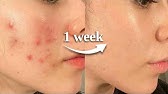 how to HEAL YOUR SKIN BARRIER in 1 week *naturally*