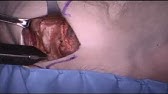 Dr. Claude Sagi: Full Sequence, Anterior Intra-Pelvic Approach