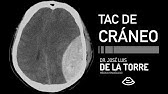 ¿Cómo Interpretar Tomografía de Cráneo? - TUTORIAL