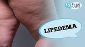 LIPEDEMA: O QUE É, SINTOMAS, DIAGNÓSTICO E TRATAMENTO