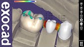 exocad Video Tutorial: Designing a Three-Element Bridge