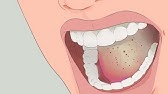 ¿Cuál es el tratamiento para la candidiasis bucal?