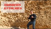 Erosiones alveolares