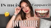 TOUT SUR MON APPAREIL DENTAIRE INVISIBLE : Bilan, coût, douleur... | Gabrielle Joséphine